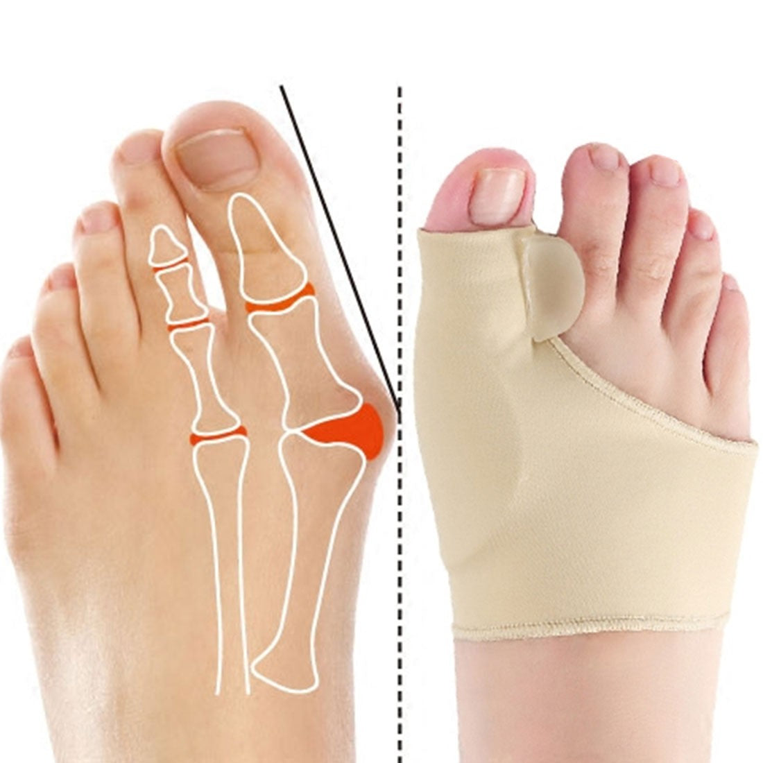 Toe Corrector Órteses pés Cuidados com os pés
